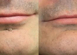 Alcuras® 2-in-1 Microneedle & Hydrocolloid Patch 🍀 | Removes Raised Moles, Acne, Flat Warts, Skin Tags, Milia & Age Spots ✨ | No Surgery Needed 🚫 | Feel Confident & Beautiful 💖 | Invisible Skin Treatment for Face & Body 🧴 | 90-Day Guarantee ✅