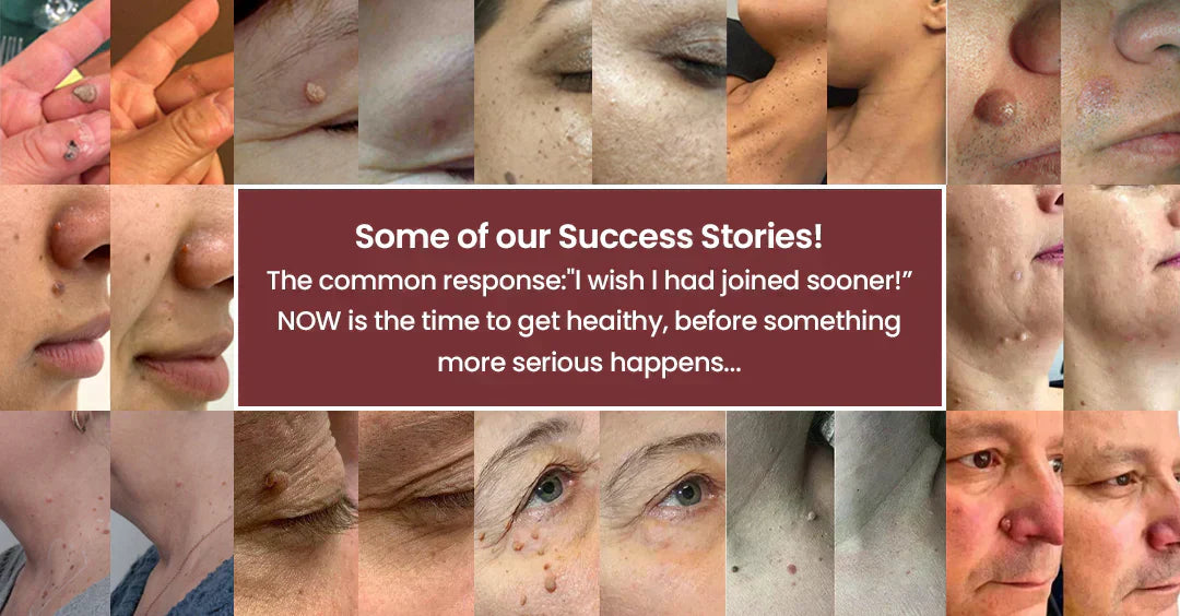 Alcuras® 2-in-1 Microneedle & Hydrocolloid Patch 🍀 | Removes Raised Moles, Acne, Flat Warts, Skin Tags, Milia & Age Spots ✨ | No Surgery Needed 🚫 | Feel Confident & Beautiful 💖 | Invisible Skin Treatment for Face & Body 🧴 | 90-Day Guarantee ✅