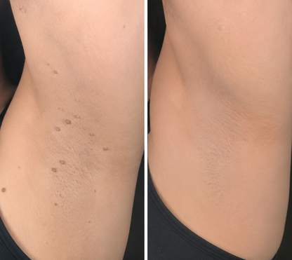 Alcuras® 2-in-1 Microneedle & Hydrocolloid Patch 🍀 | Removes Raised Moles, Acne, Flat Warts, Skin Tags, Milia & Age Spots ✨ | No Surgery Needed 🚫 | Feel Confident & Beautiful 💖 | Invisible Skin Treatment for Face & Body 🧴 | 90-Day Guarantee ✅