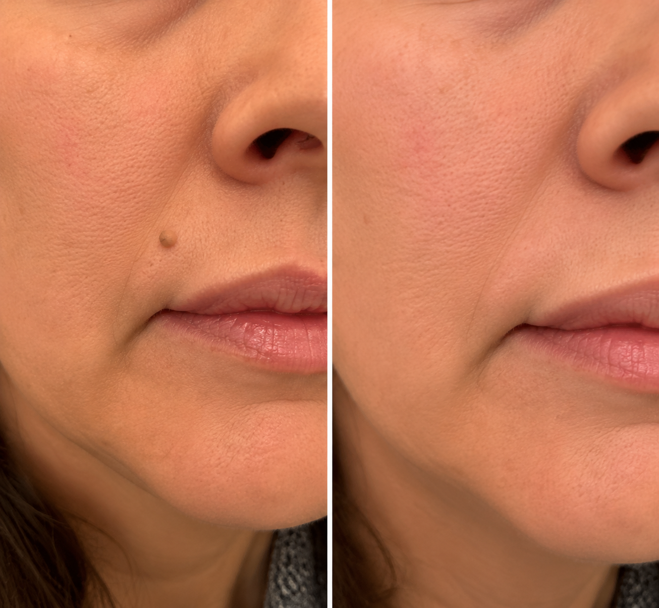 Alcuras® 2-in-1 Microneedle & Hydrocolloid Patch 🍀 | Removes Raised Moles, Acne, Flat Warts, Skin Tags, Milia & Age Spots ✨ | No Surgery Needed 🚫 | Feel Confident & Beautiful 💖 | Invisible Skin Treatment for Face & Body 🧴 | 90-Day Guarantee ✅