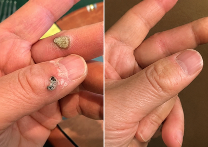 Alcuras® 2-in-1 Microneedle & Hydrocolloid Patch 🍀 | Removes Raised Moles, Acne, Flat Warts, Skin Tags, Milia & Age Spots ✨ | No Surgery Needed 🚫 | Feel Confident & Beautiful 💖 | Invisible Skin Treatment for Face & Body 🧴 | 90-Day Guarantee ✅